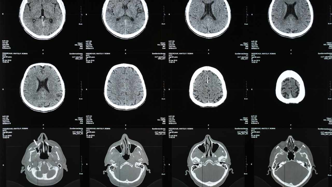 New Haven Traumatic Brain Injury Attorney