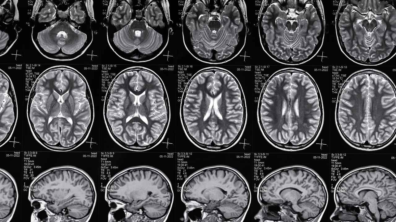 Long Island Traumatic Brain Injury Attorney