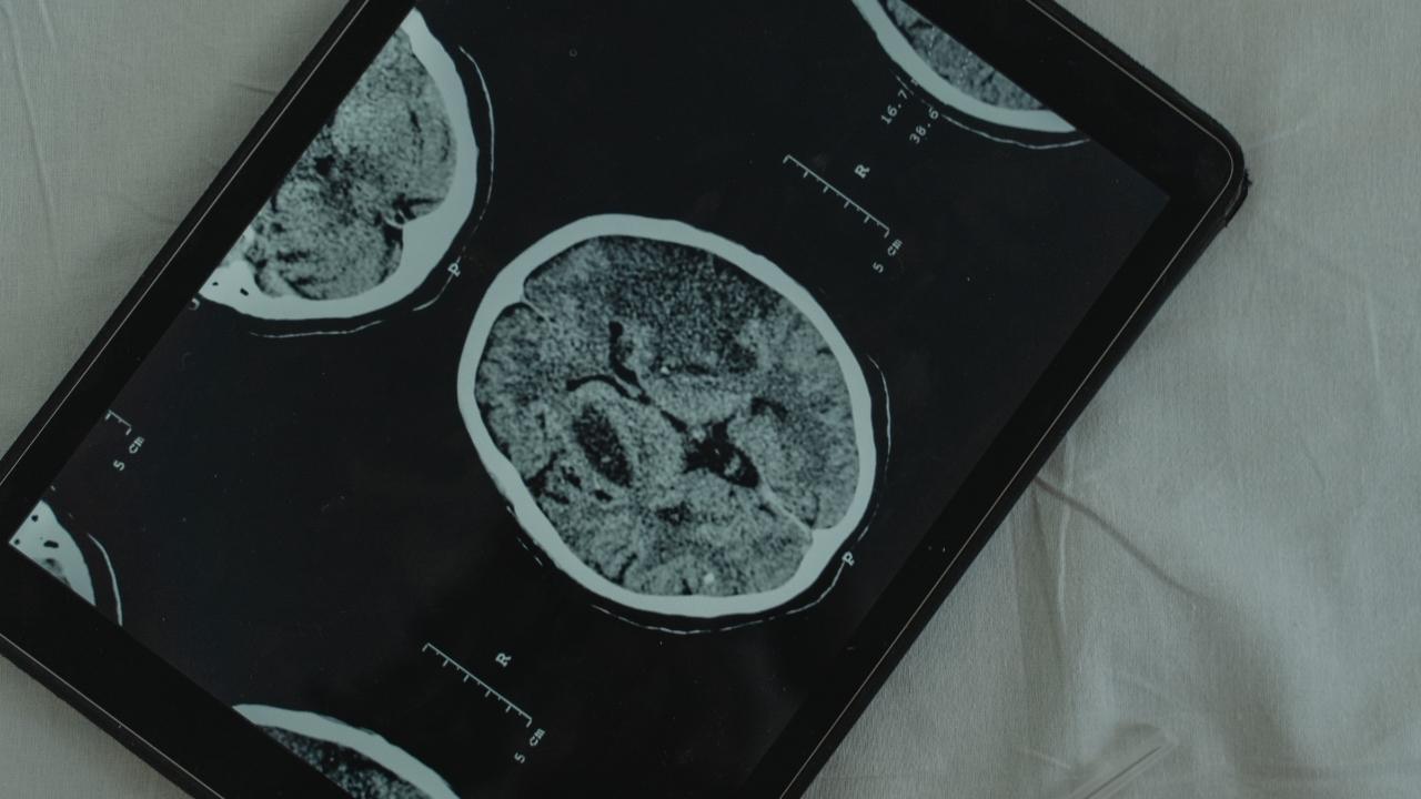 Melville Traumatic Brain Injury Attorney