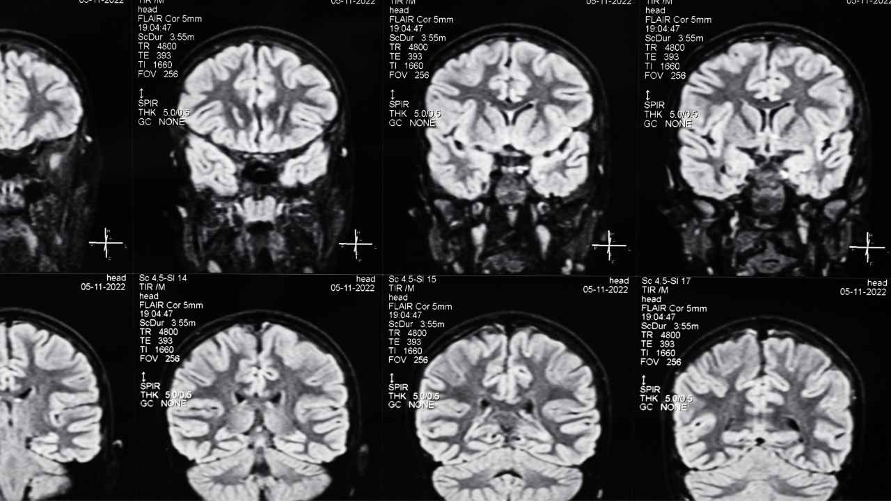 Riverhead Traumatic Brain Injury Attorney
