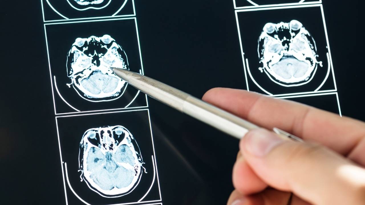 Torrington Traumatic Brain Injury Attorney