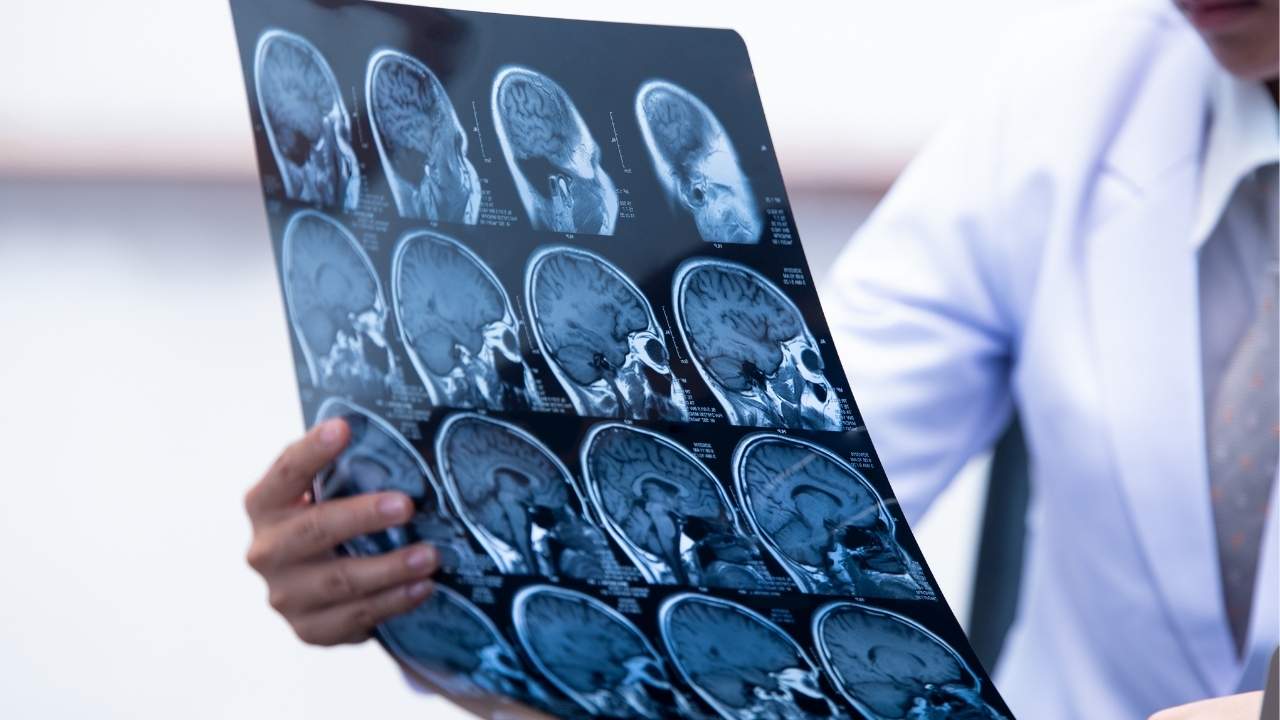 Waterbury Traumatic Brain Injury Attorney